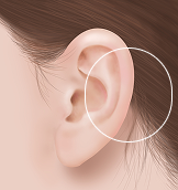 귓바퀴 필러 After